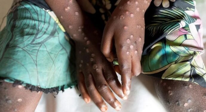 İsveç’te M çiçeği vakası